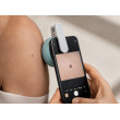 DermLite HÜD — osobní dermatoskop pro kontrolu znamének | Harrmed Medical